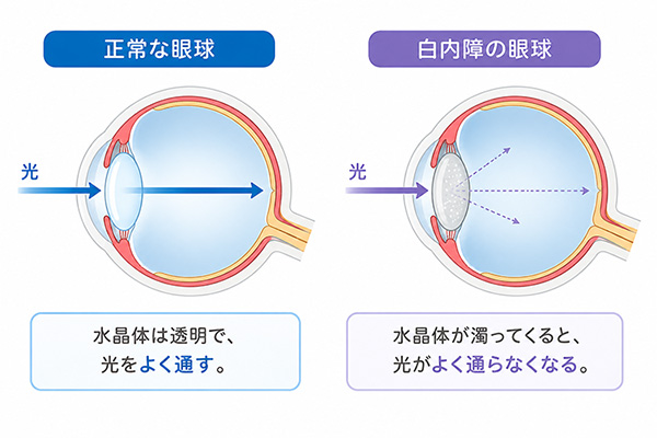 白内障の説明図